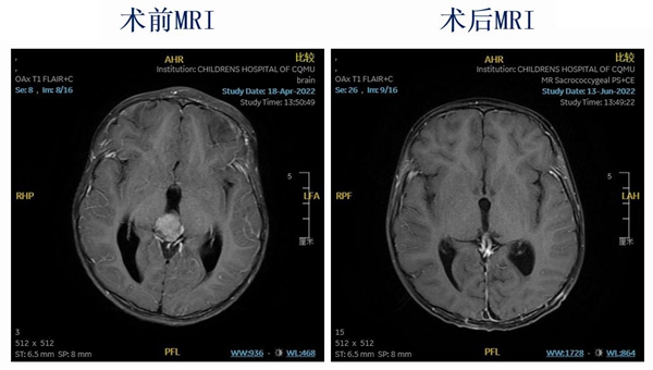 手術(shù)前后造影對比。重醫(yī)附屬兒童醫(yī)院供圖