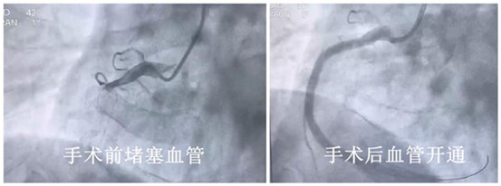 手術(shù)前后血管狀態(tài)。重慶康心醫(yī)院供圖