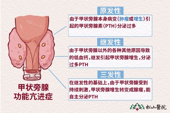 甲狀旁腺類型。重慶松山醫(yī)院供圖