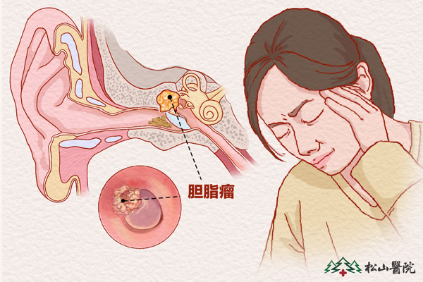 膽脂瘤。重慶松山醫(yī)院供圖