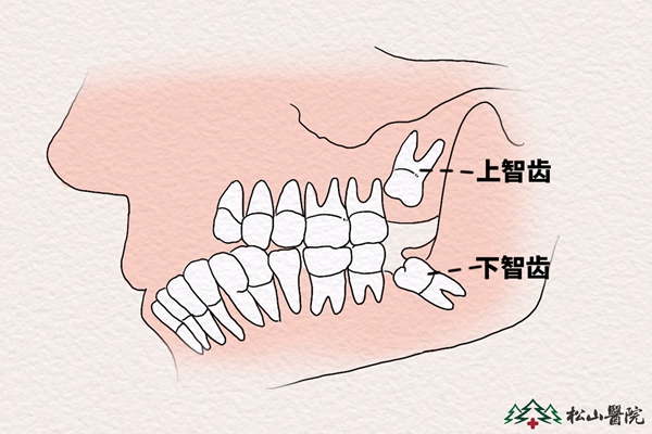 孕期智齒疼痛能不能拔？松山醫(yī)院口腔專家告訴你