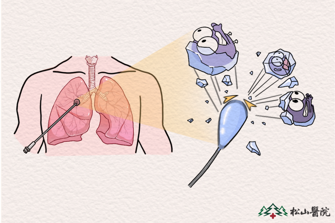 冷凍消融。重慶松山醫(yī)院供圖