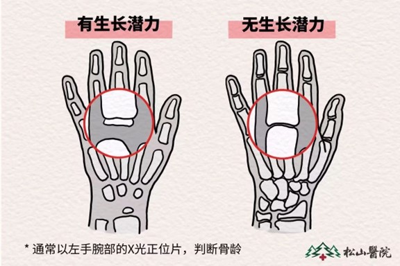 骨齡監(jiān)測。重慶松山醫(yī)院供圖